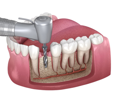 Root Canal Treatment Timeline Explained