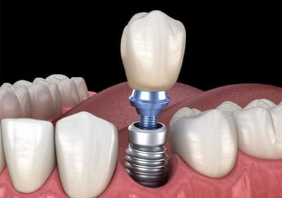Achieve a Flawless Smile in Dubai with Single Tooth Implant