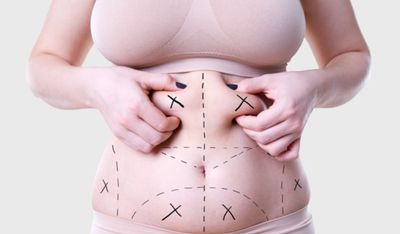 How to Maintain Results After Laser Liposuction in Dubai