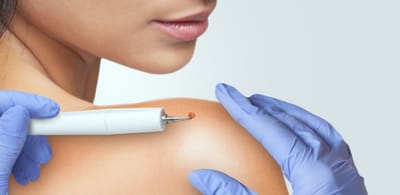 Quick Guide to Skin Tag Removal in Dubai