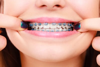 Supporting Your Teen With Braces in Dubai