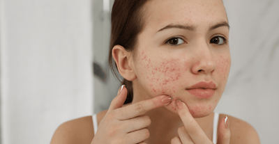 What’s the Best Way to Treat Acne in Dubai?