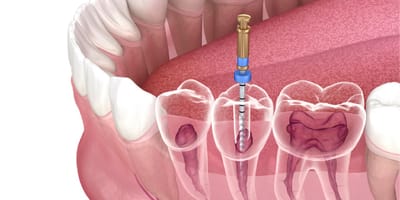 Root Canal Treatment in Dubai for Deep Decay