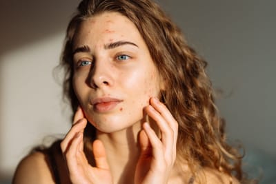Set Your Skin Goals with Acne Treatment in Dubai