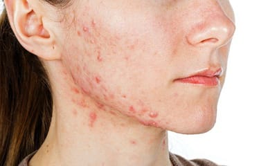 Join the Clear Skin without acne Movement in Dubai