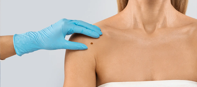 Skin Tag Removal and Daily Hygiene Dubai
