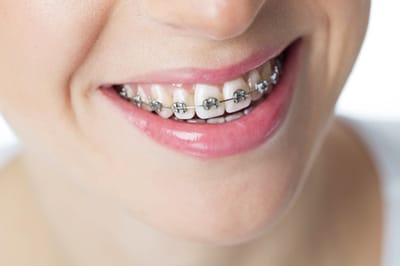Adult Journey: Teeth Braces Costs in Dubai