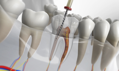 How Long It Takes to Recover from Root Canal Treatment in Dubai