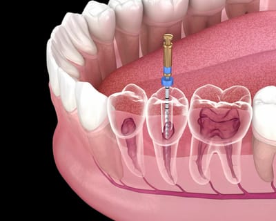 Smile Better After Root Canal Treatment in Dubai