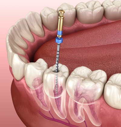 How Root Canal Treatment in Dubai Enhances Appearance