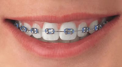 Who Can Help Finance Teeth Braces Costs in Dubai?