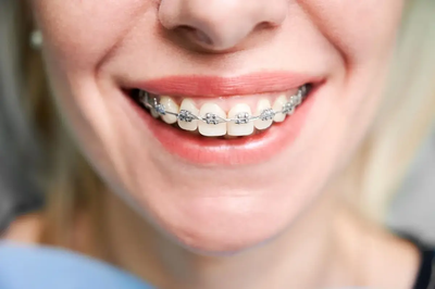What Influences Teeth Braces Costs in Dubai by Age?