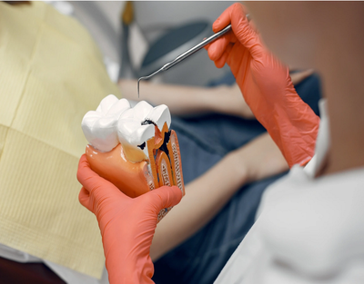 Root Canal Treatment in Dubai for Broken Teeth