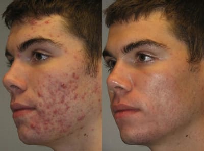 When to Combine Facials with Acne Treatment Dubai?