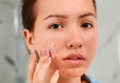 How to Prepare for Acne Treatment Dubai?