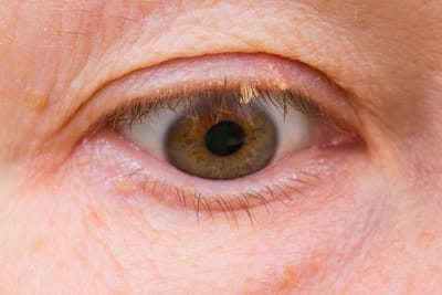 Why Laser Skin Tag Removal in Dubai Is Effective
