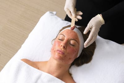 Maximize Glow with Chemical Peel in Dubai
