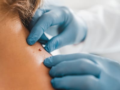 Why Skin Tag Removal Is Recommended by Dermatologists