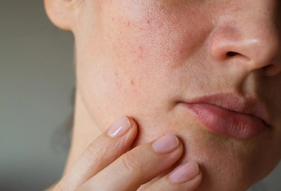 What Is the Large Pores Treatment Cost in Dubai?