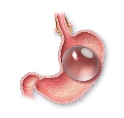 Why People Prefer Gastric Balloon Placement