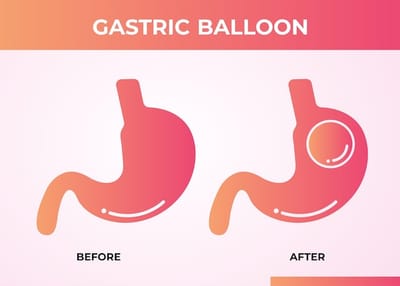 Who Can Get Gastric Balloon Placement