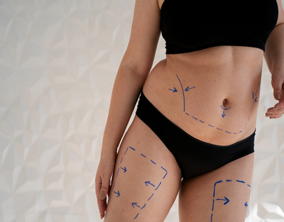 What Makes Laser Liposuction So Effective?
