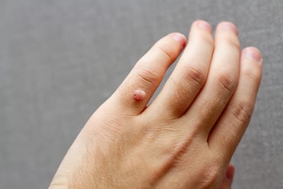 Why Men Are Turning to Warts Removal Treatments
