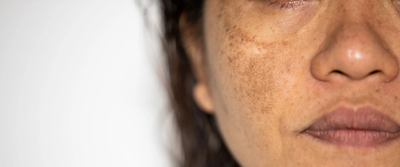 Why Experts Recommend Melasma Treatment in Dubai