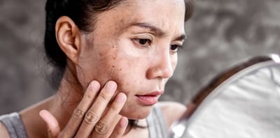 How Safe Is Modern Melasma Treatment in Dubai