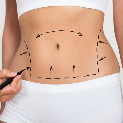 When Should You Consider Laser Liposuction in Dubai?