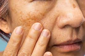 Who Sees Fast Results with Melasma Treatment in Dubai?