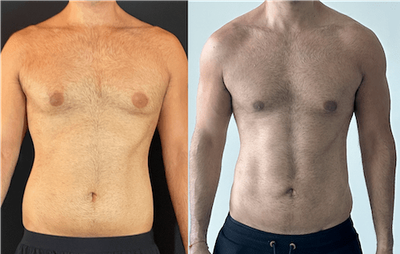 Who Determines Gynecomastia Surgery Cost In Dubai?