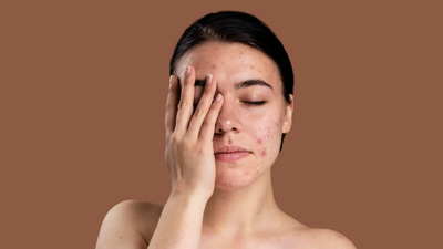 Why Acne Treatment Works for Oily Skin