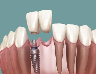 Single Tooth Implant Price Planning