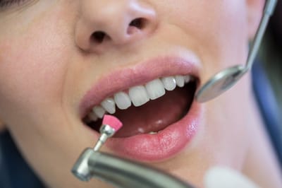 How Teeth Whitening Cost in Dubai Is Determined