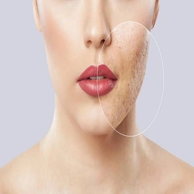 Large Pores Treatment Cost in Dubai for Oily Skin Types