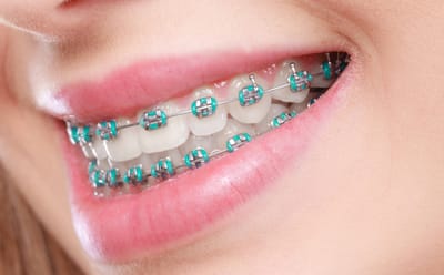 Teeth Braces Cost in Dubai and Oral Health Goals