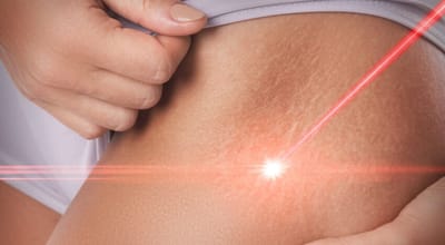 Why Scar Removal Dubai Is Searched by Young Adults