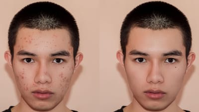 When Acne Treatment Dubai Is Used for Mild Breakouts