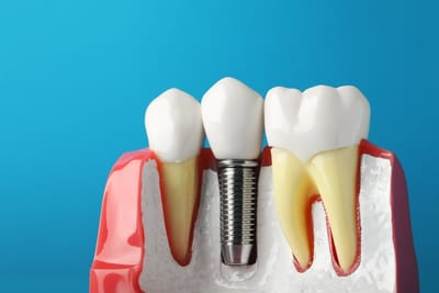 Single Tooth Implant Pricing Without Stress