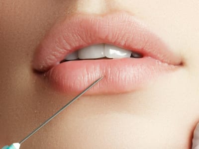 Why Russian Lip Fillers in Dubai Give Natural Results
