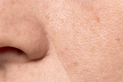 Which treatment used for Large Pores Treatment and cost