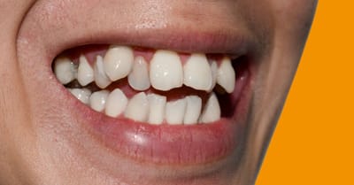 What Are the Best Crooked Teeth Treatments in Dubai?