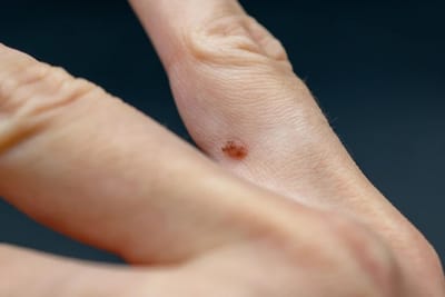 What Patients Ask About Skin Wart Removal Cost in Dubai?