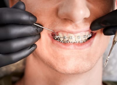 When Is the Best Age for Dental Braces in Dubai?