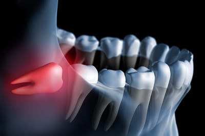 Why Swollen Gums Need Wisdom Tooth Extraction in Dubai