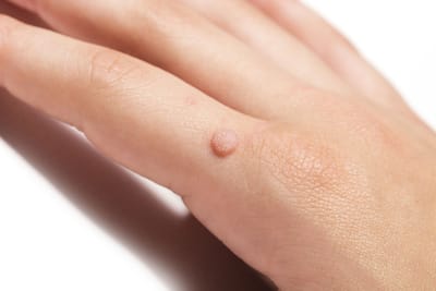 Understanding Laser Warts Removal How It Works and Who Needs It?