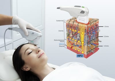 Before and After HIFU Treatment: Realistic Expectations