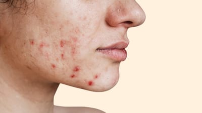 What Happens During Professional Acne Care?