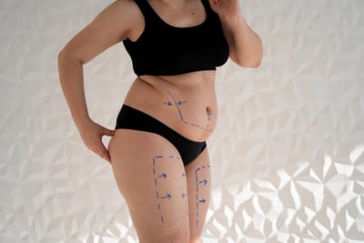 Why Does Liposuction Uae Need Realistic Expectations?